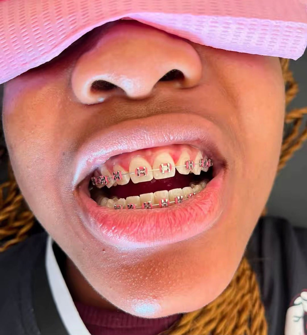 Standard Braces