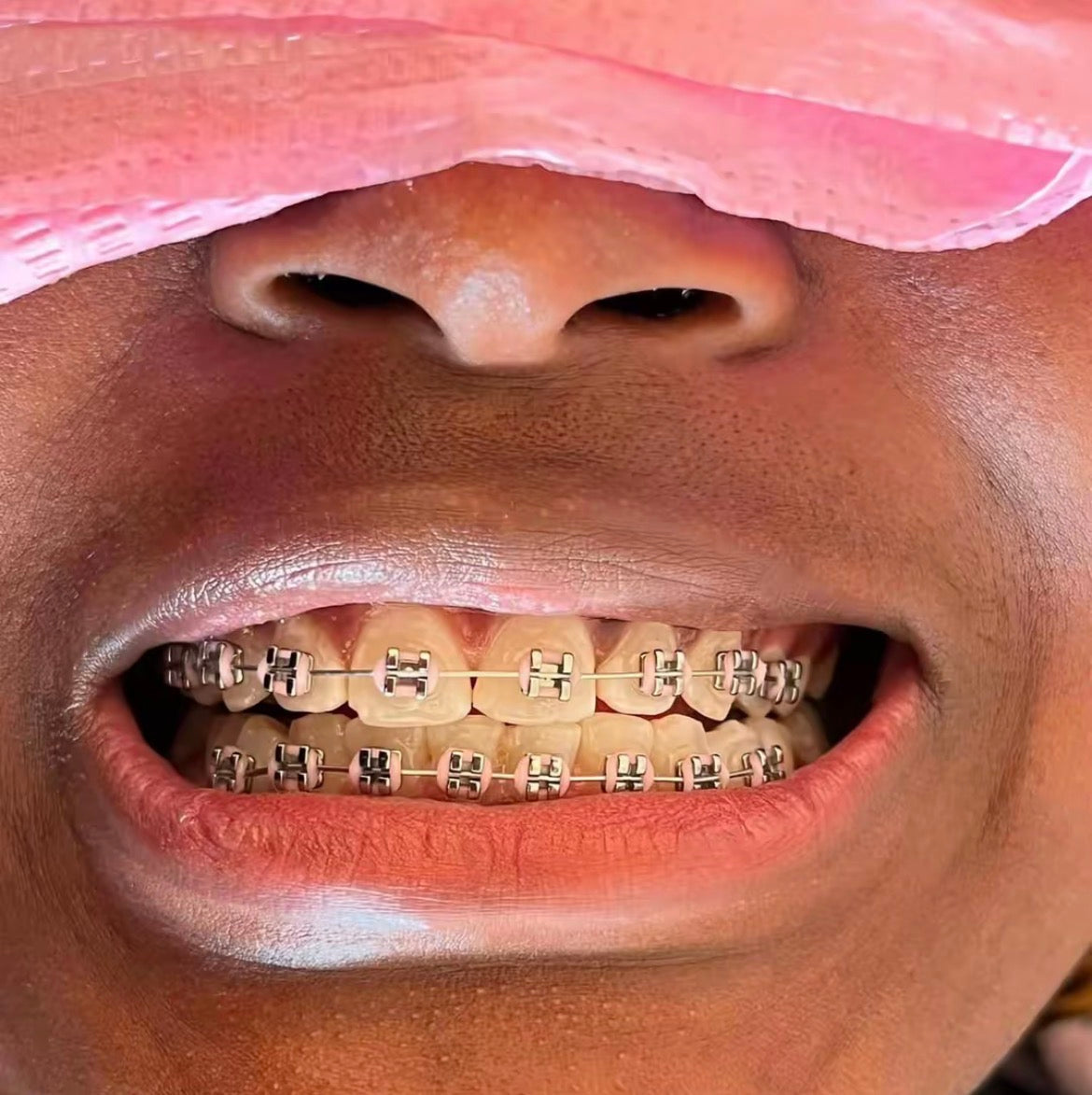 Standard Braces
