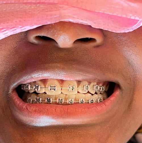 Standard Braces
