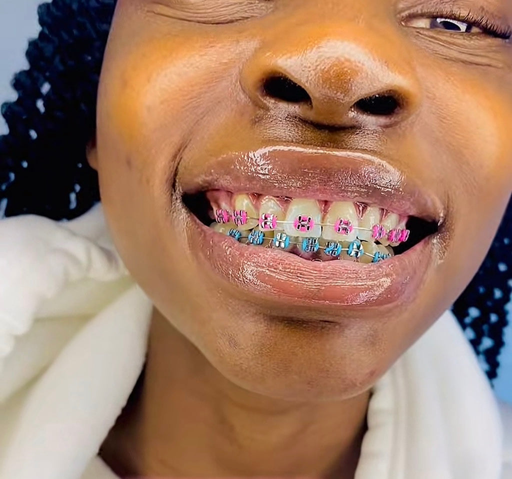 Standard Braces