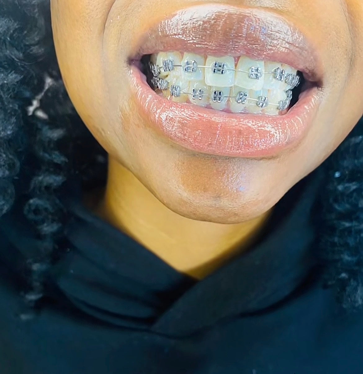 Standard Braces
